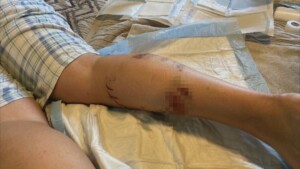 Muskie Attacks Winnipeg Woman in Northern Ontario